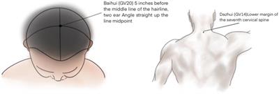 Transcutaneous electrical acupoint stimulation for reducing cognitive dysfunction in lumbar spine surgery: A randomized, controlled trail